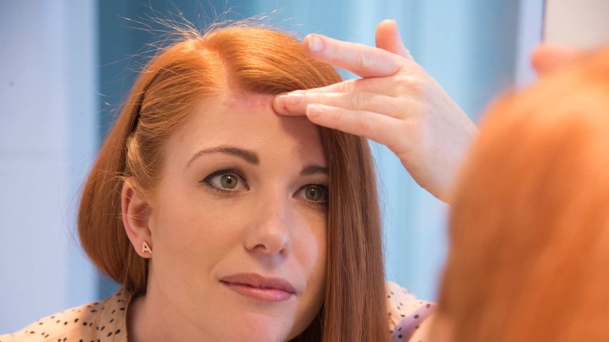 A woman looking in the mirror at a scar on her forehead.