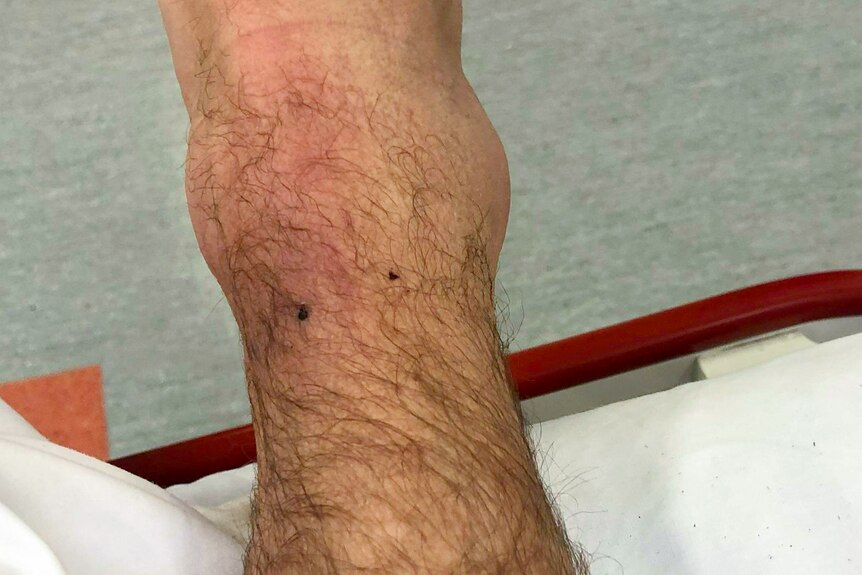 Two bloody fang marks on a swollen ankle in a hospital bed 