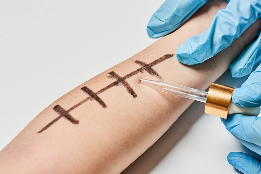 arm extended with marks as doctor does skin prick test