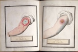 A drawing of an arm infected with smallpox and an arm infected with cow pox