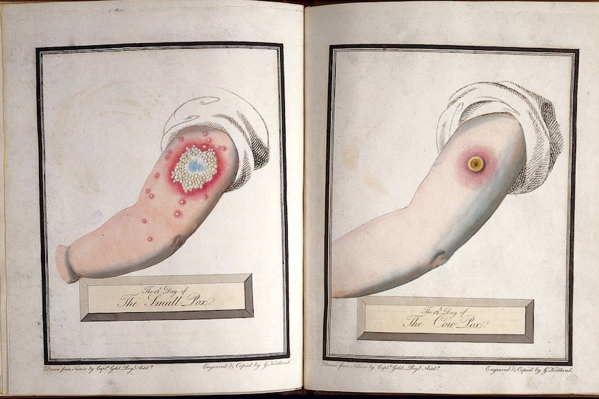 A drawing of an arm infected with smallpox and an arm infected with cow pox