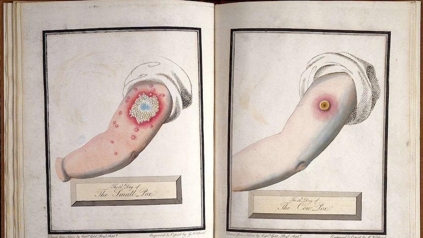 A medical print comparing the effects of a smallpox inoculation to a milder cowpox vaccination