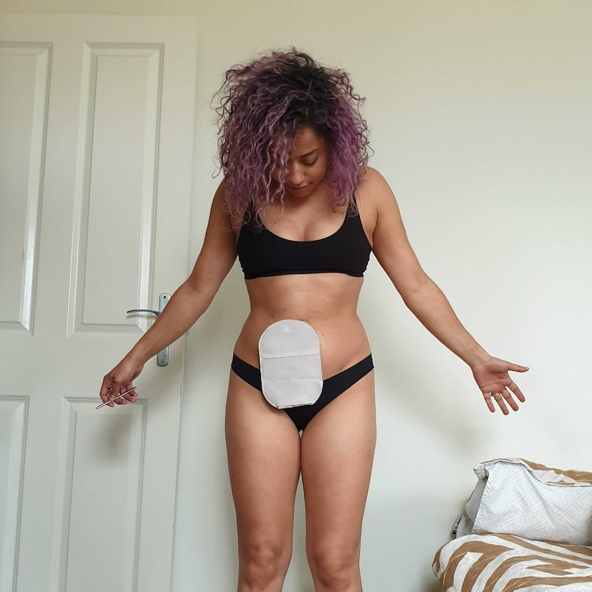 A woman in her underwear proudly showing her ileostomy bag