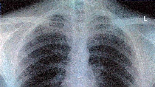 x-ray chest image