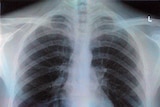x-ray chest image