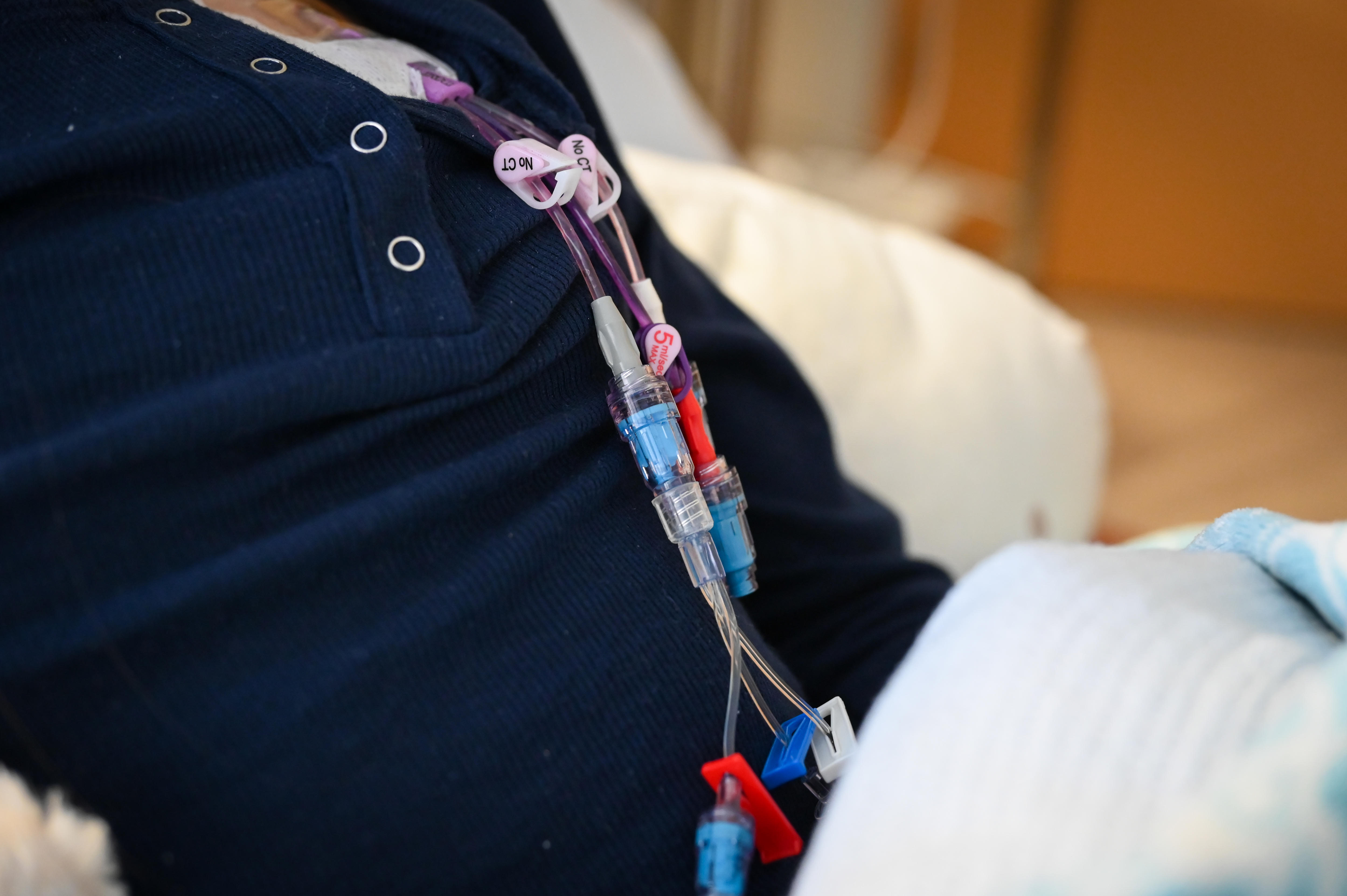 Cables de hospital conectados al pecho de una mujer. Lleva un top azul marino. 