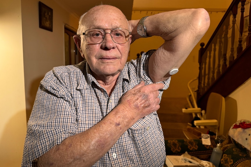Walter Buldo pointing to the device attached to his arm, which helps monitor his glucose levels.