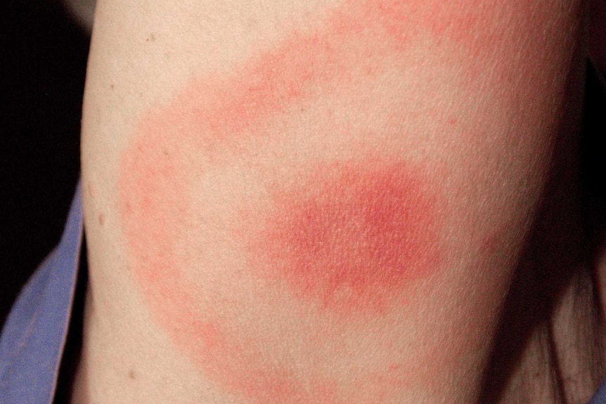 Bulls eye rash