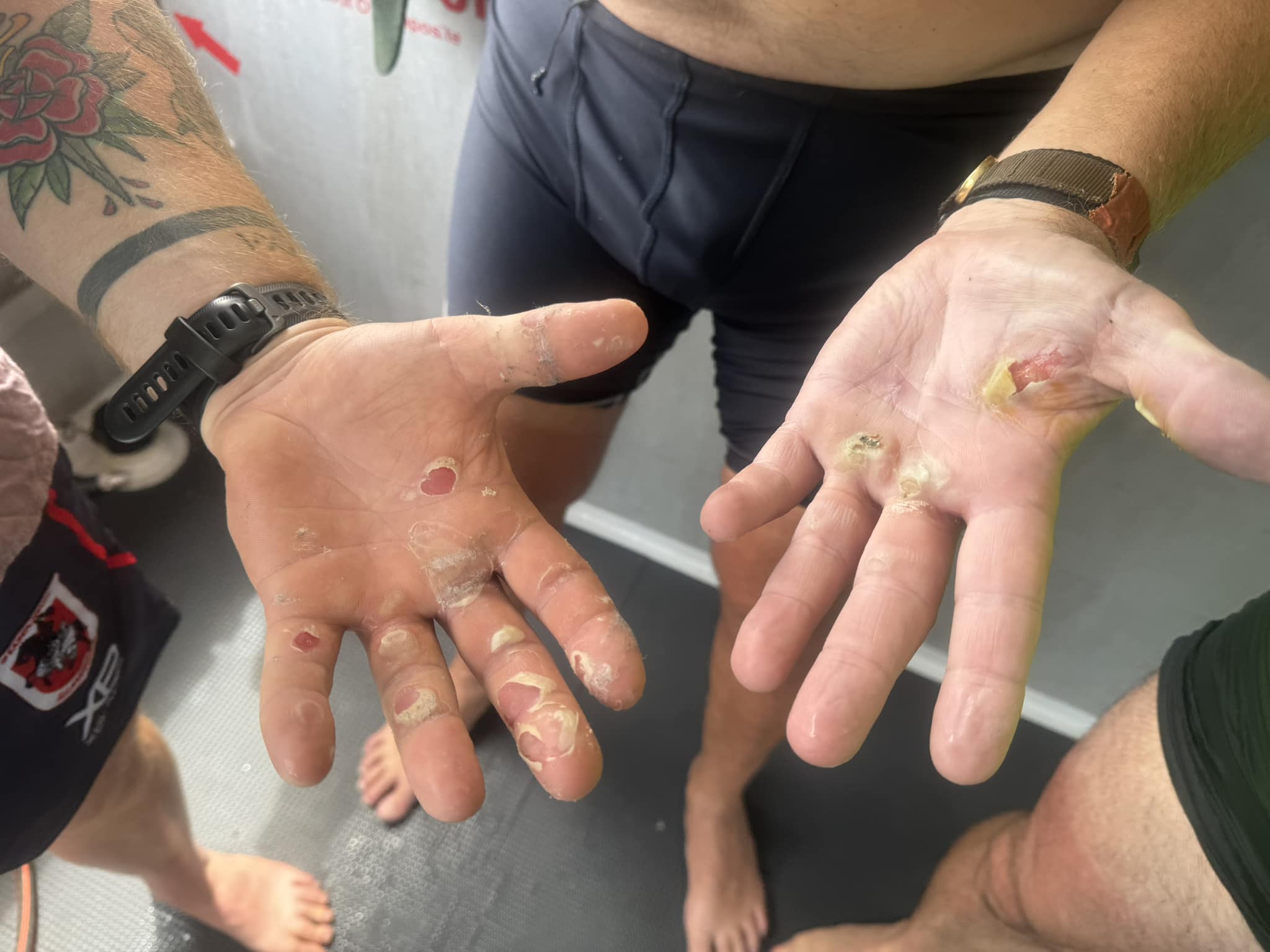 A close up of two men's hands with some serious blisters.
