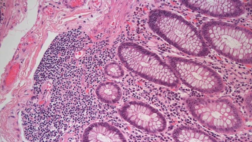 A tissue section of bowl cancer