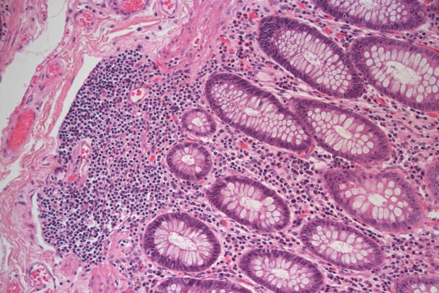 A tissue section of bowel cancer