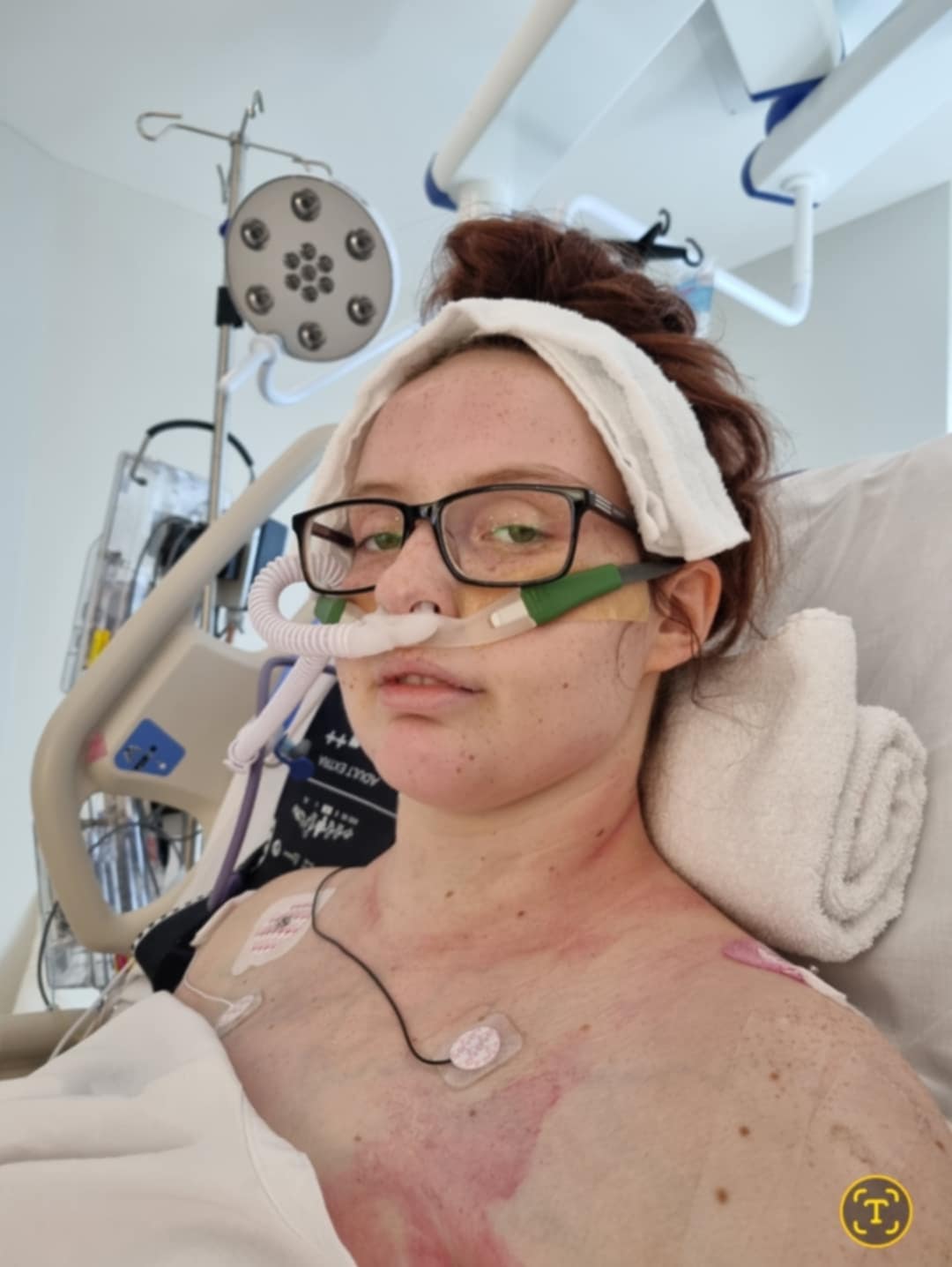 young girl in hospital bed with tubes going into her nose