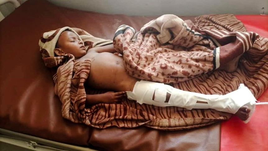 A child lying on a bed receives treatment for injuries sustained in an air strike.