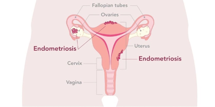 Grafika wewnętrznego narządu rozrodczego kobiety z kropkami przedstawiającymi miejsca, w których można znaleźć endometriozę.