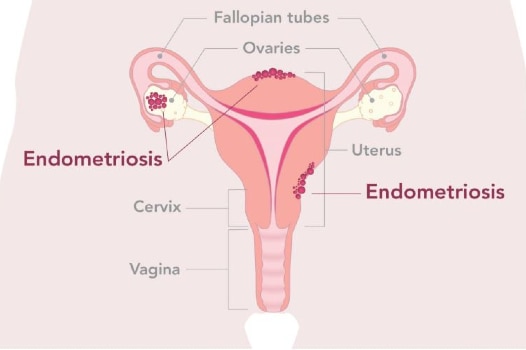 Diagram of uterus that shows endometrial-like tissue growing in the fallopian tubes.