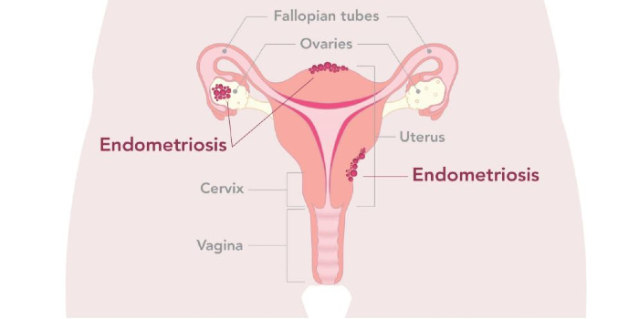 Graphic of a woman's internal reproductive organ with dots depicting where endometriosis can be found.