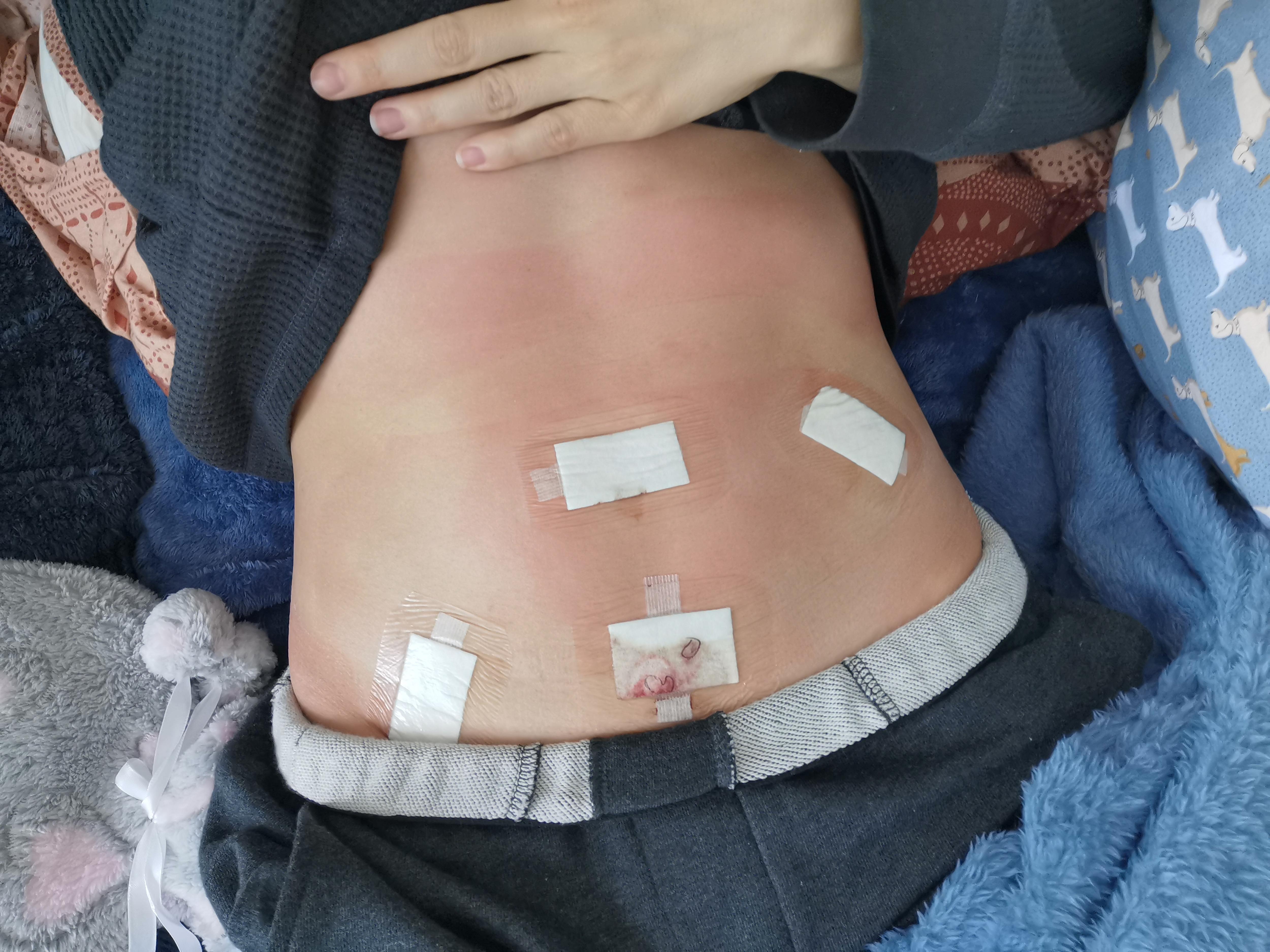 photograph of stomach with plasters on it