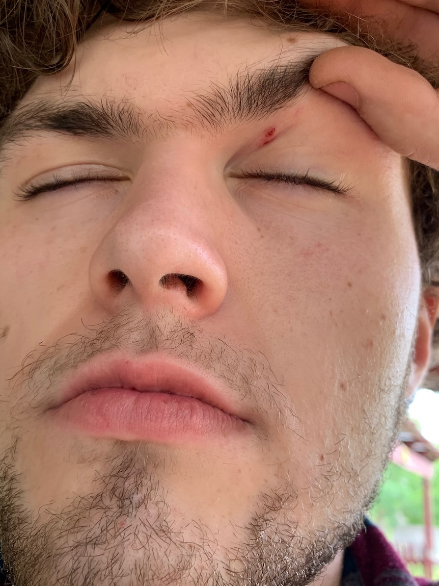 A selfie of a young man with an injured eyelid.