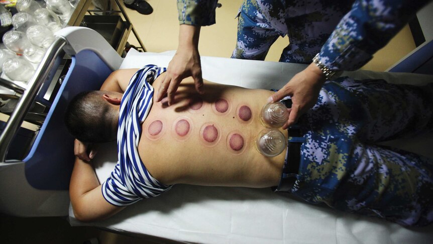 A man lying on a hospital bed receives cupping therapy. There are two cups on his back and several two rows of red circles.