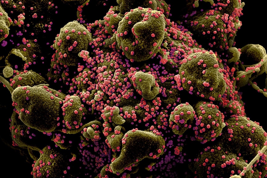 A dying cell (greenish-brown) heavily infected with SARS-CoV-2 virus particles (pink), isolated from a patient sample.