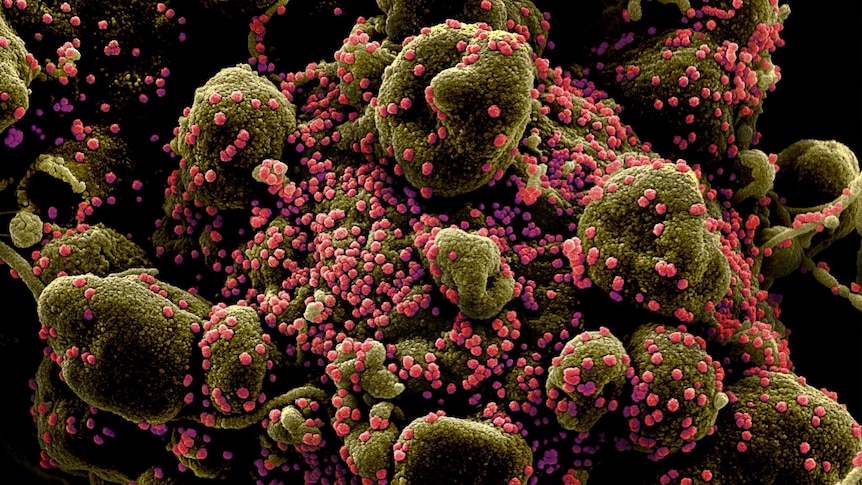 A dying cell (greenish-brown) heavily infected with SARS-CoV-2 virus particles (pink), isolated from a patient sample.
