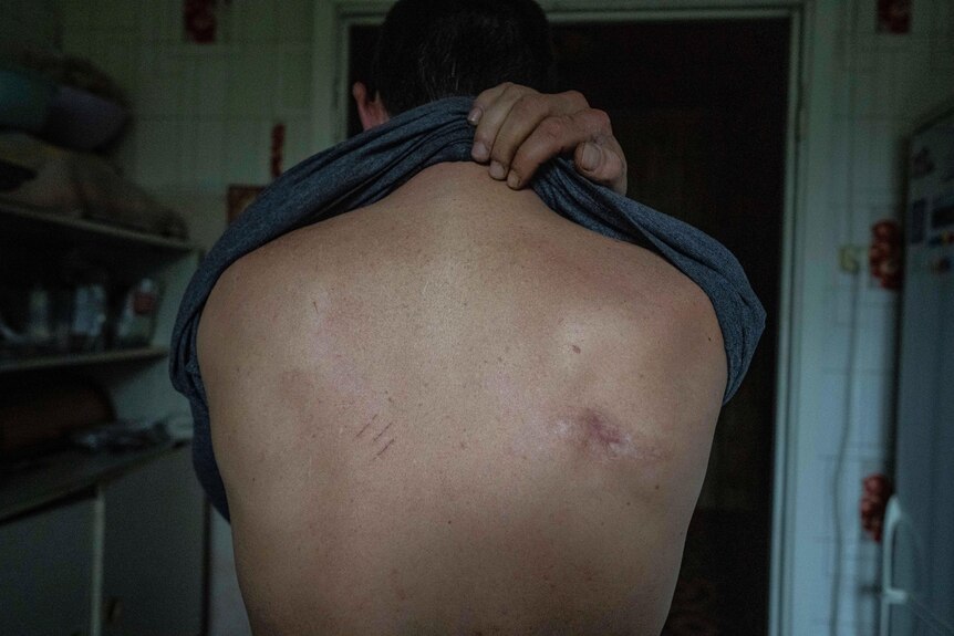 A white man's bare back shows scars and signs of abuse.