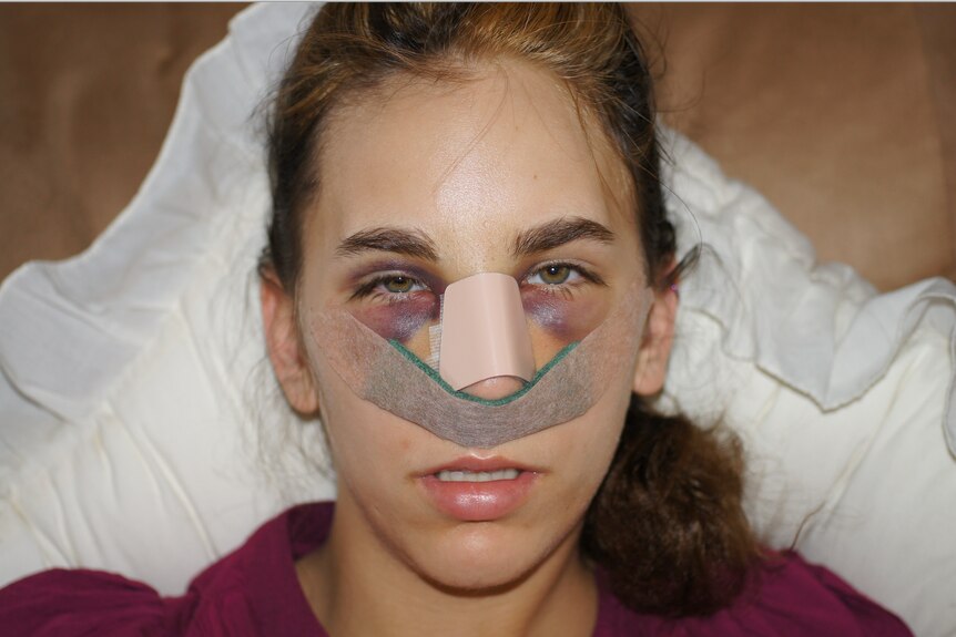 Close up image of Amy Clark, a nurse assaulted by a patient of hers, with a broken nose.