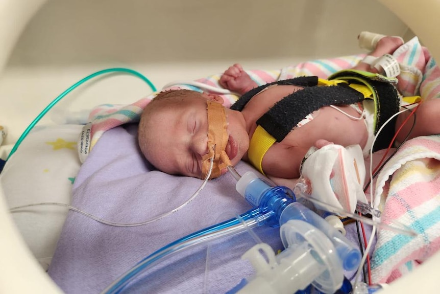 Baby Menasheh is connected to tubes as he lays in a cot