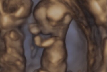 An ultrasound of twins in the womb.