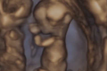 An ultrasound of twins in the womb.
