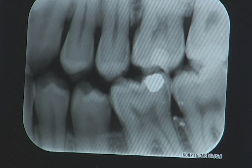 Tooth X-ray