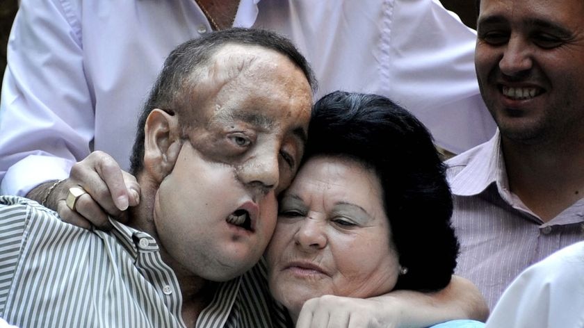 Rafael hugs his mother after undergoing a face transplant