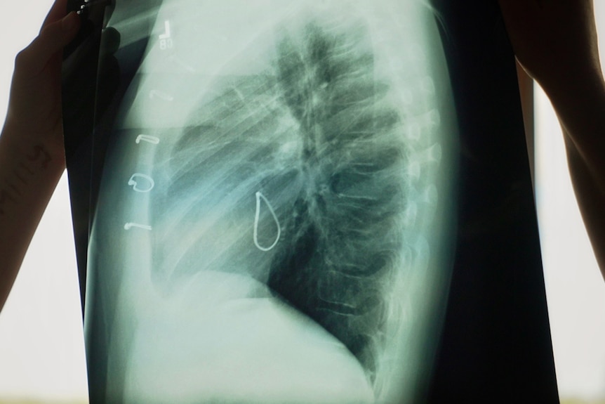 An X-ray of a chest.