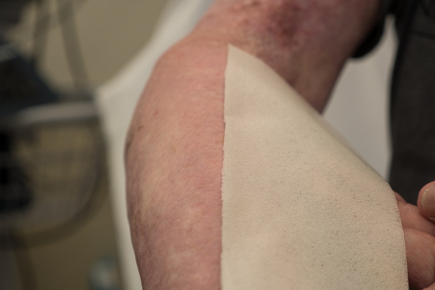 Expandable dressing on John Weeks' arm.