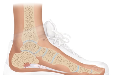 Diagram of plantar fasciitis pain.