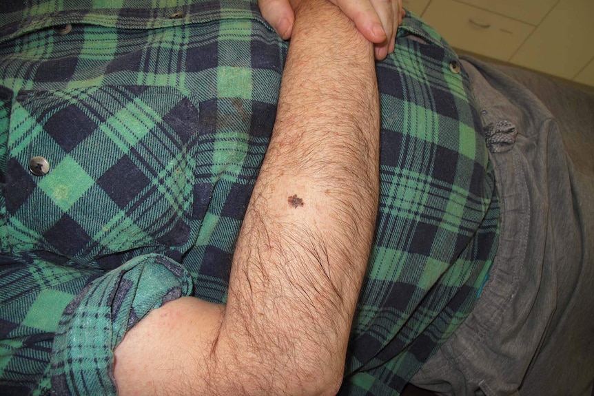 A man's arm showing a mole deemed to be a melanoma risk