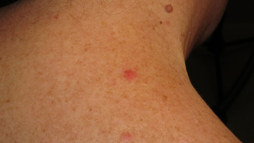 Basal cell carcinoma on a patient during a clinical examination in March 2016