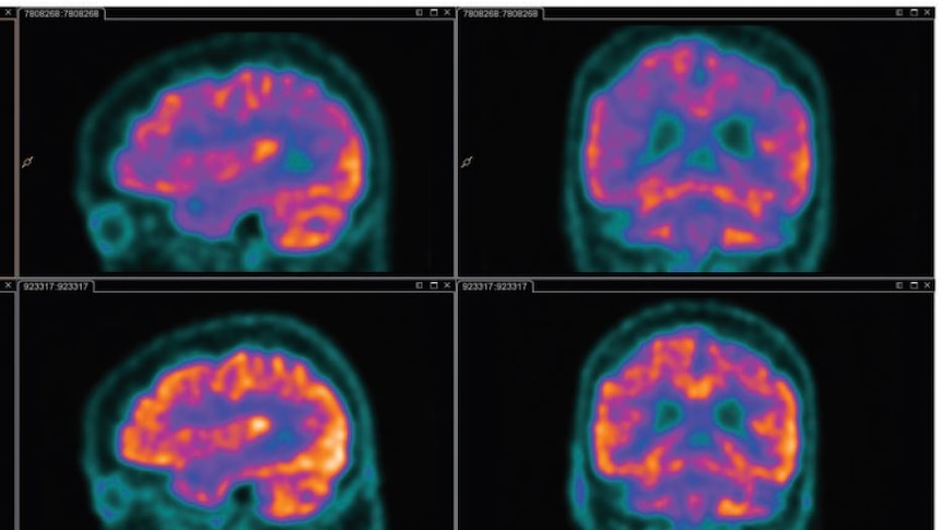 The top row is the delirium PET scan, the bottom one is after the delirium.