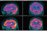 The top row is the delirium PET scan, the bottom one is after the delirium.