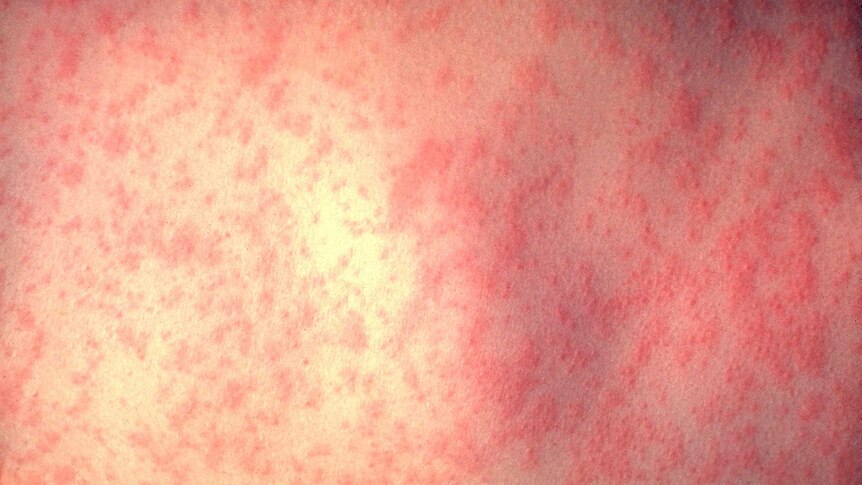 Three day measles infection