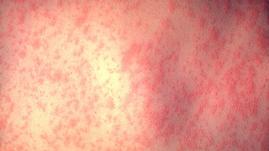 Skin of a patient after three days of measles infection.