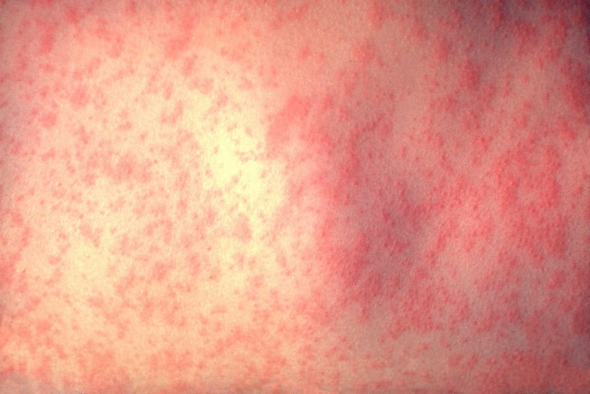 Three day measles infection