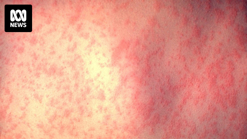 Measles alert in multiple locations across Adelaide after teenager tests positive