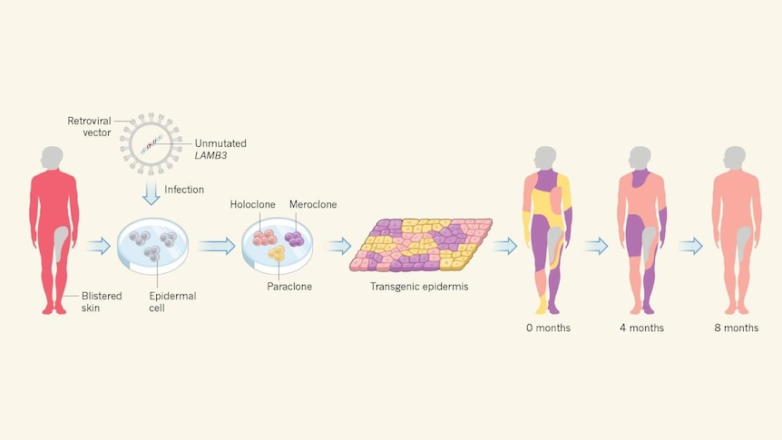 Diagram showing skin cells, genetically modified, can treated the disease junctional epidermolysis bullosa.