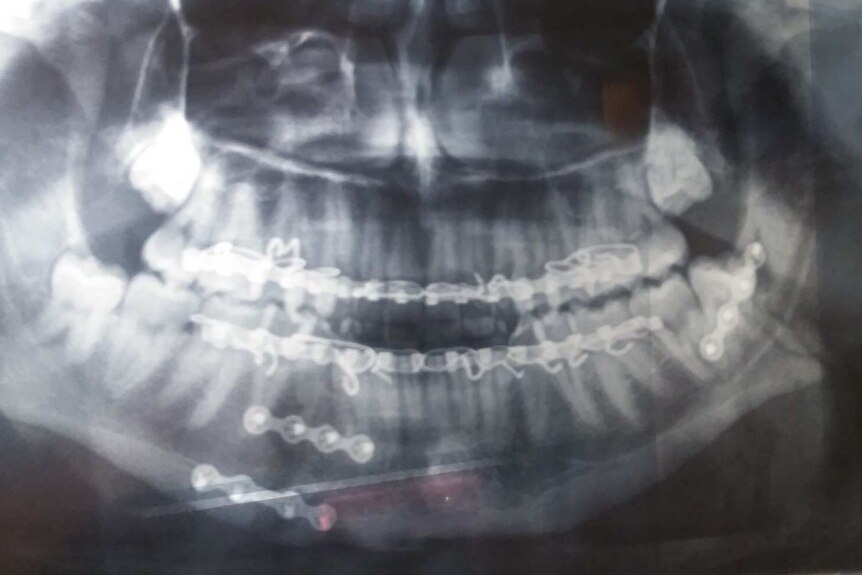 An x-ray showing medical screws inserted after jaw surgery.