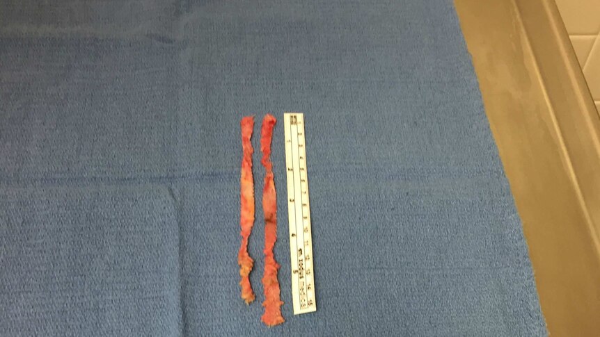 A mesh device after it has been removed.