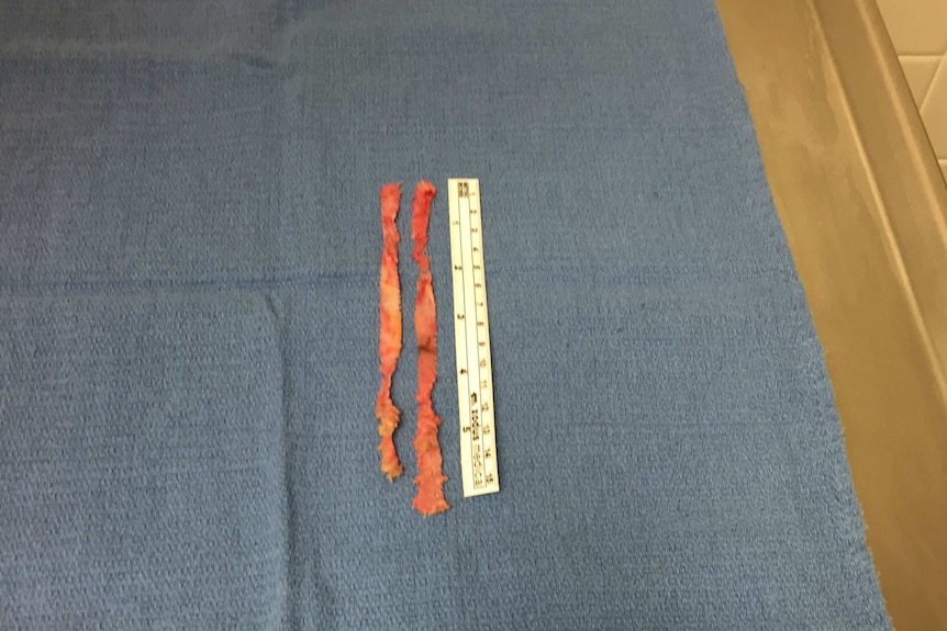 A mesh device after it has been removed.