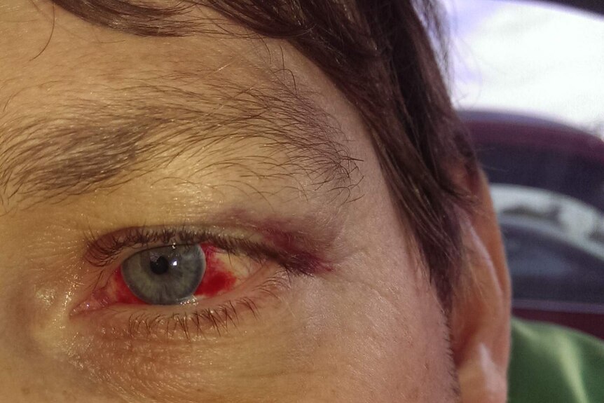Jason Coulstock's black eye