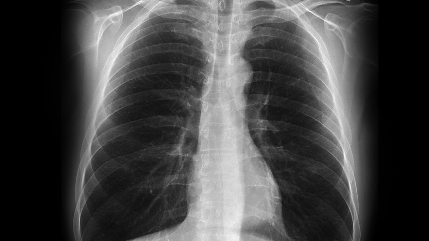 A set of lungs affected by black lung disease.