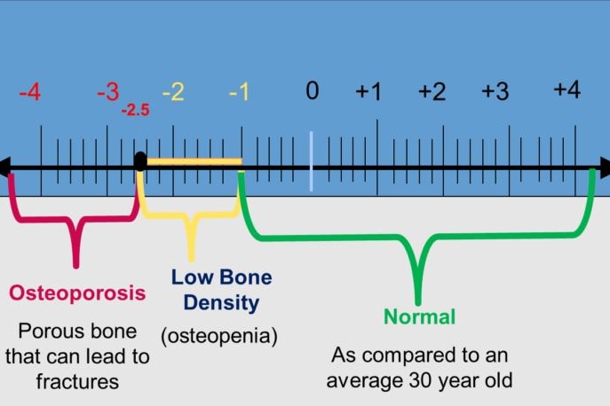 A scale showing the numerical values representing low bone density and normal density